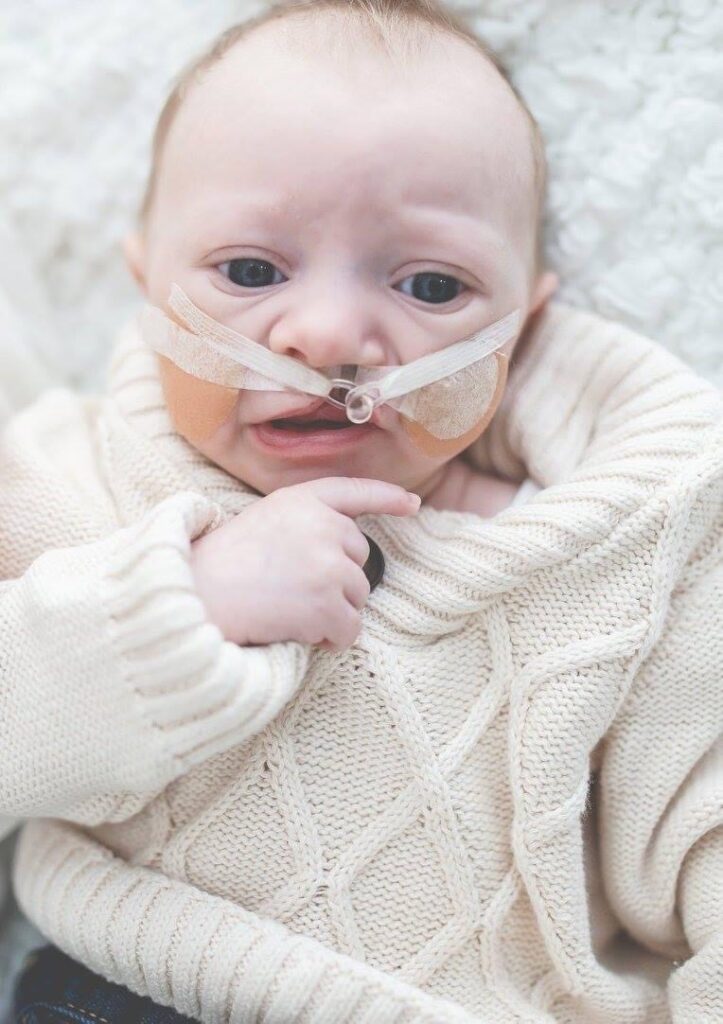 Baby Charlie wearing an off-white knitted sweater. Charlie was born with cleft lip and palate.